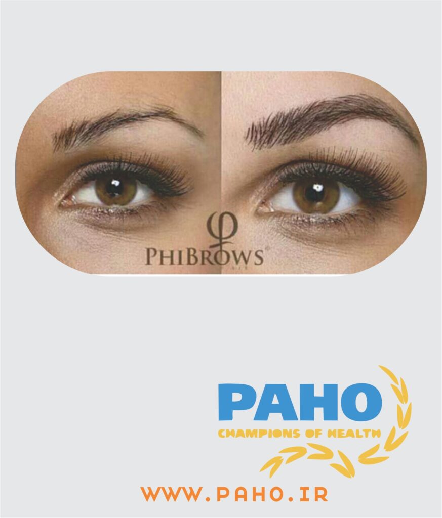 میکروبلیدینگ ابرو به روش فیبروز