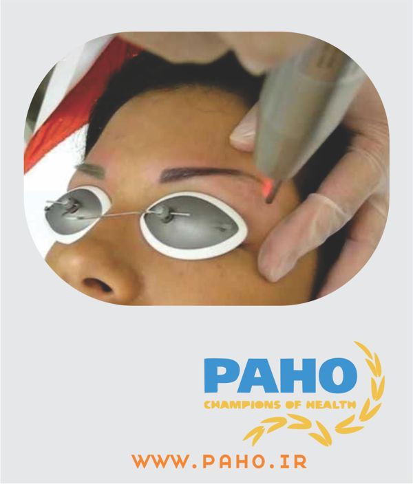 پاک کردن تاتو