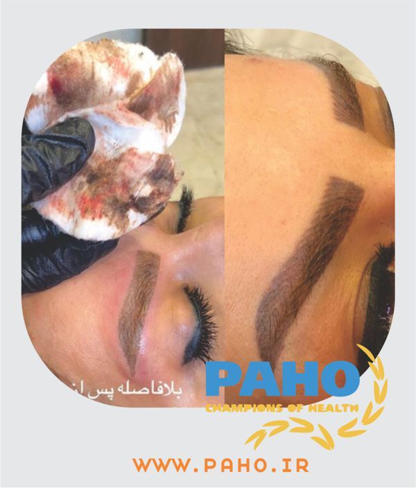 پاک کردن تاتو خط چشم