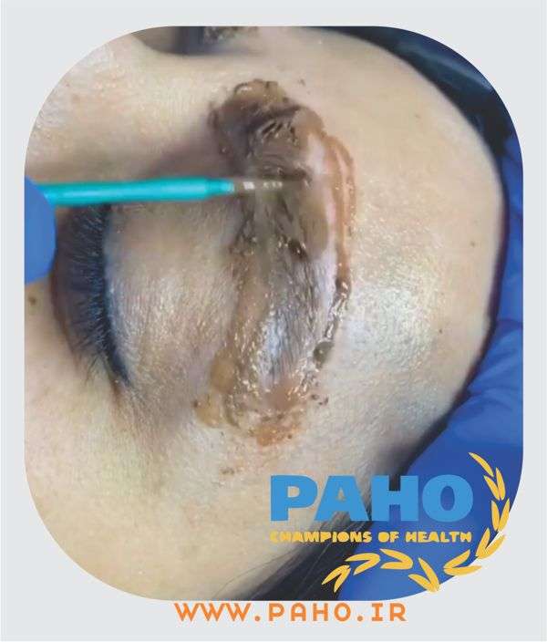 پاک کردن تاتو ابرو در ساری