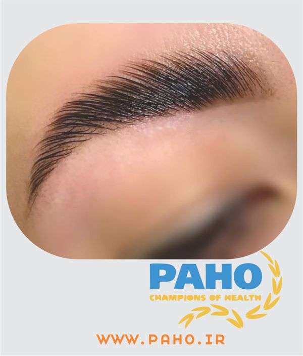 لیفت ابرو در اصفهان