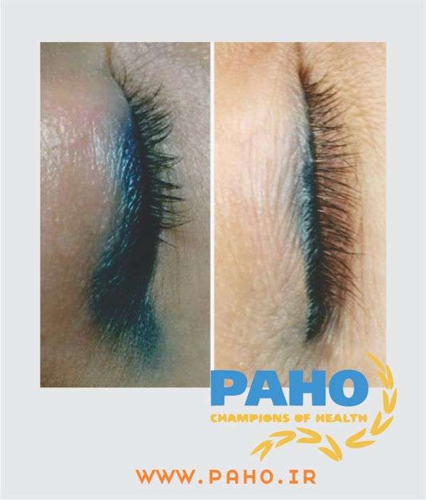 بهترین مراکز پاک کردن تاتو ابرو در اصفهان