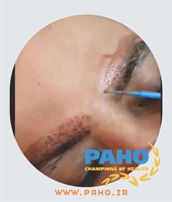 آموزش پاک کردن تاتو ابرو