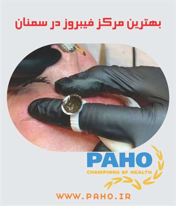 فیبروز ابرو در سمنان