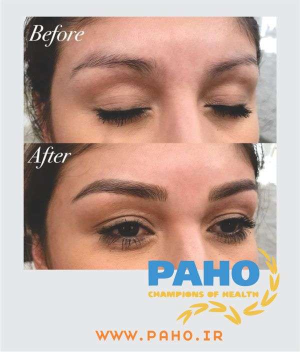 آموزش فیبروز ابرو در کرج