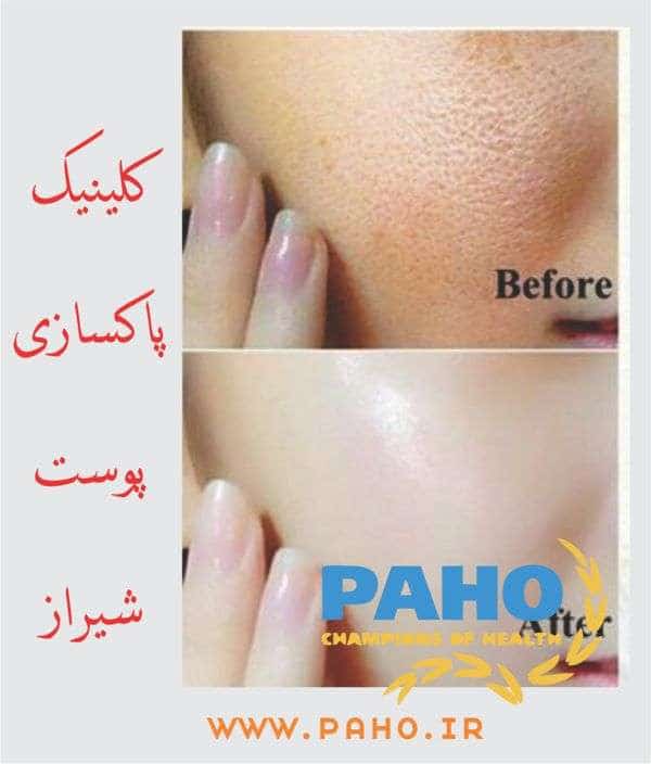 کلینیک پاکسازی پوست شیراز