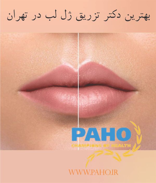 بهترین دکتر تزریق ژل لب