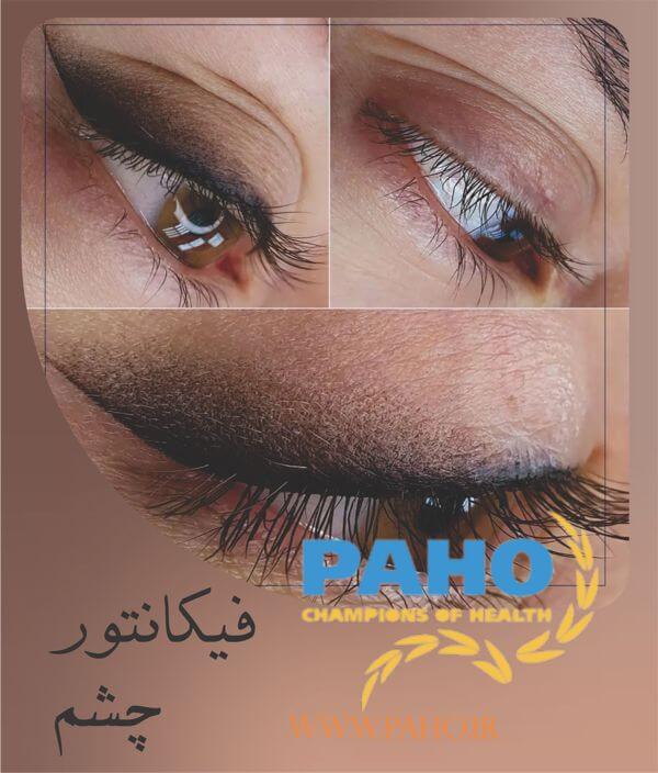 فیکانتور چشم