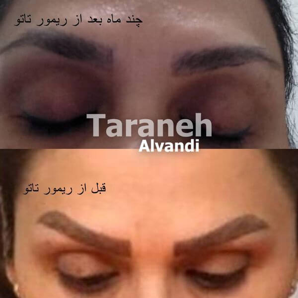 ریموو ابروی تک جلسه ای