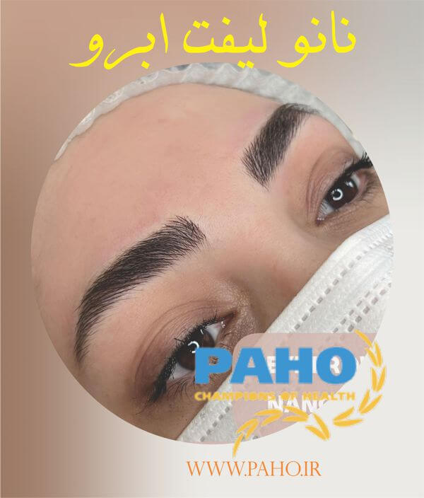 نانو لیفت ابرو