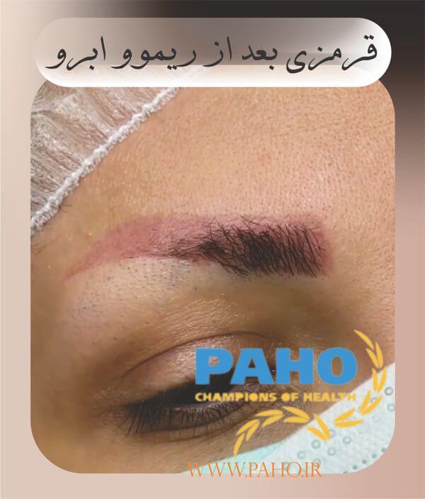 قرمزی بعد از ریموو ابرو