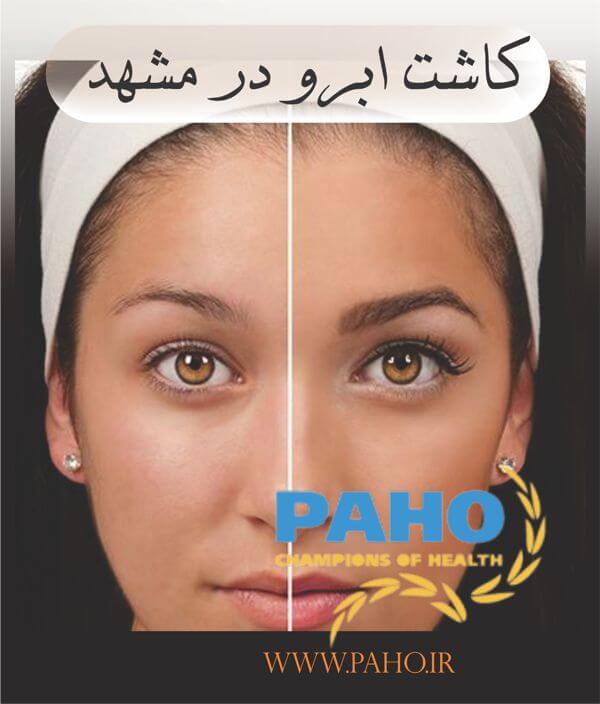 کاشت ابرو در مشهد