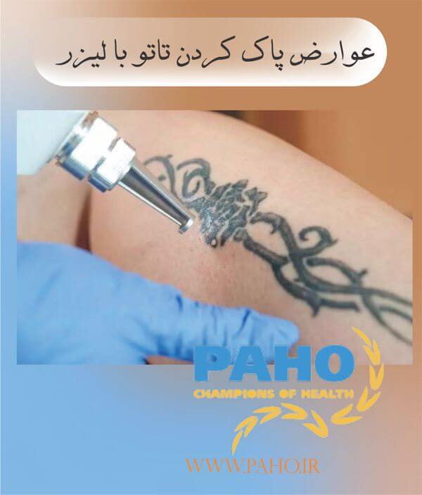 عوارض پاک کردن تاتو با لیزر