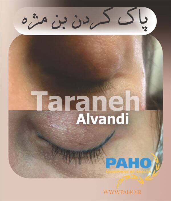 پاک کردن بن مژه