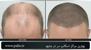 بهترین مراکز اسکالپ سر در مشهد