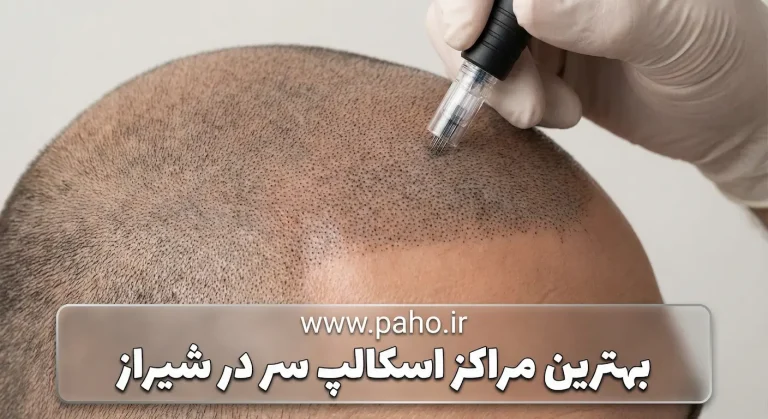 اسکالپ سر در شیراز