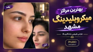 میکروبلیدینگ مشهد