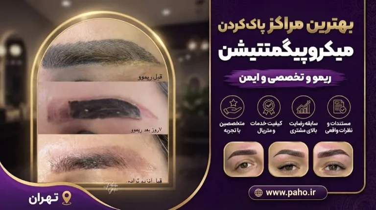 بهترین مراکز پاک کردن میکروپیگمنتیشن